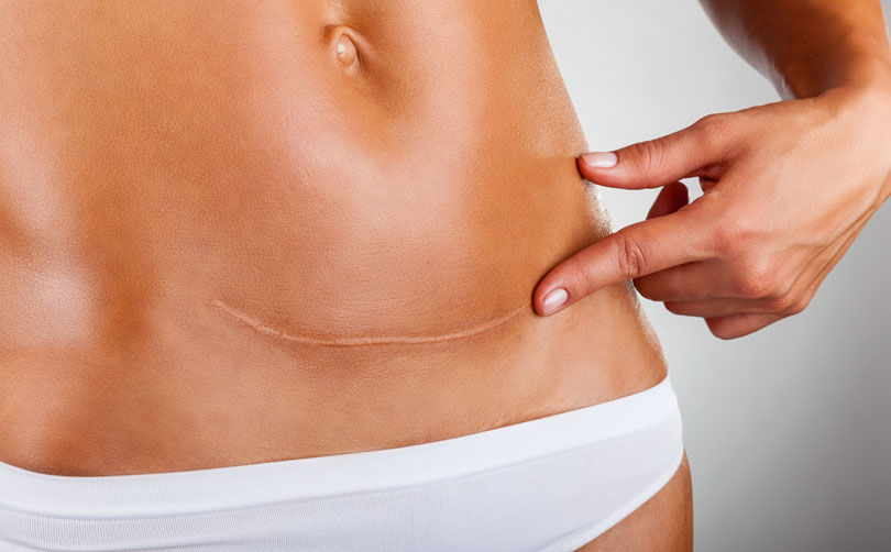 Caesarean v. Vaginal Delivery